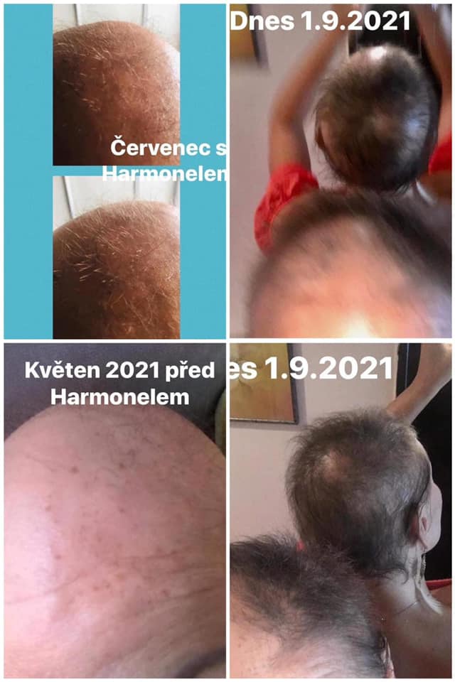 harmonelo recenze alopecie
